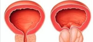 علاج نهائي لتضخم البروستاتا