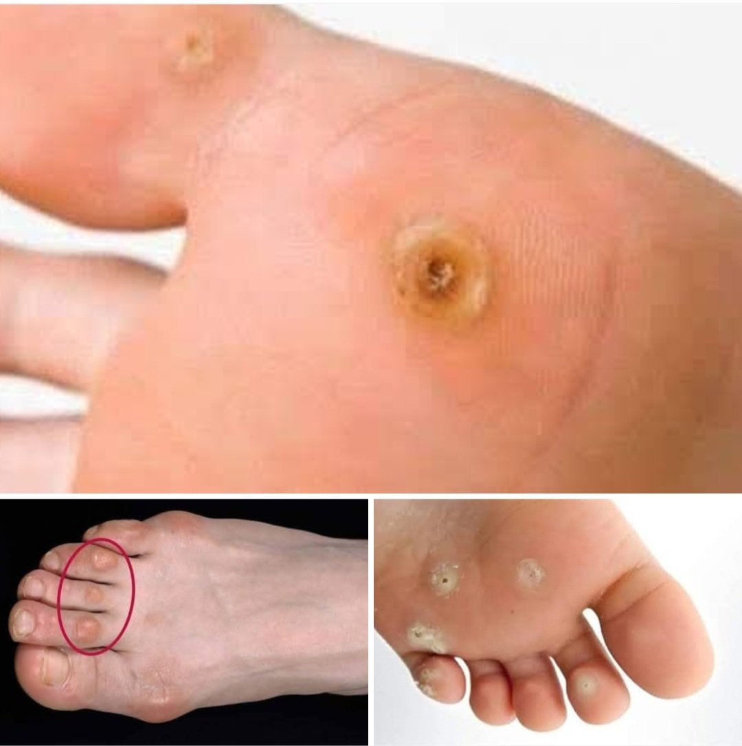 علاج عين السمكه بالاعشاب