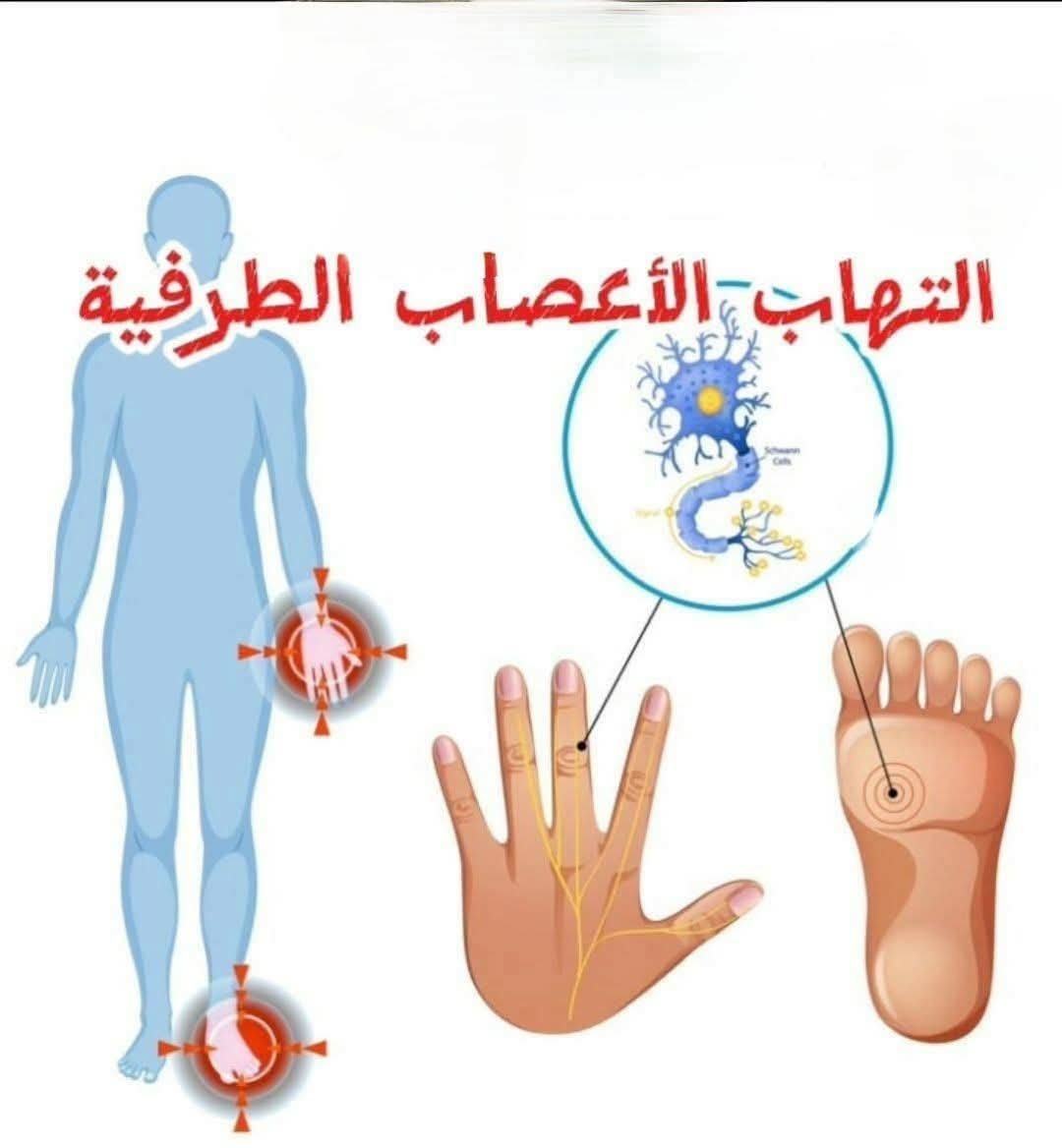 كيفيه علاج التهاب الاعصاب الطرفيه