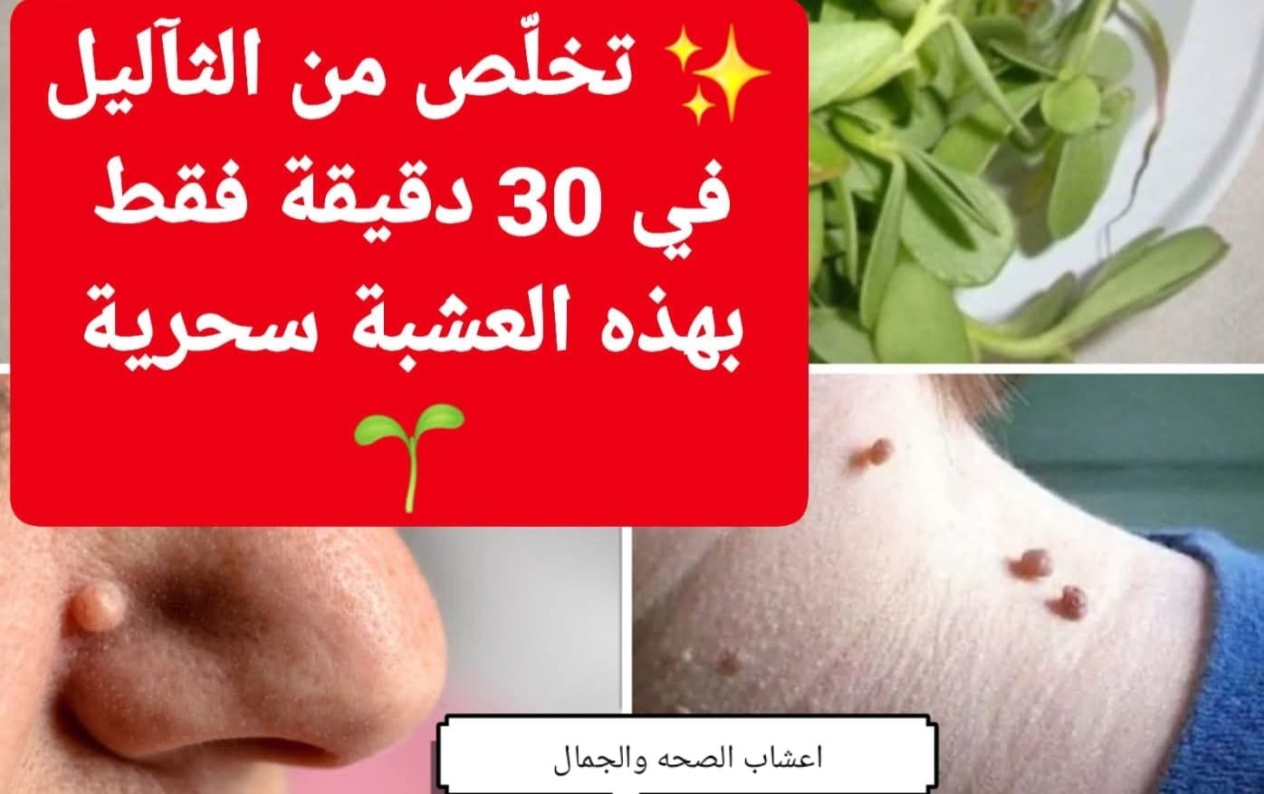 ما هو العلاج النهائى للثاليل