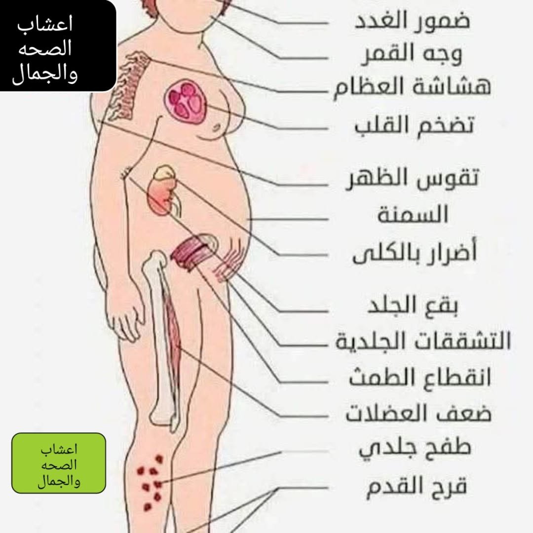 علامات ارتفاع هرمون الكورتيزول