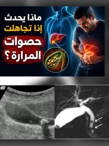 ماذا يحدث إذا تجاهلت حصوات المرارة؟