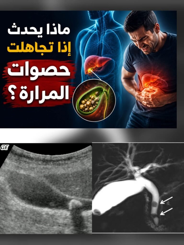 ماذا يحدث إذا تجاهلت حصوات المرارة؟